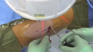 Overview of Instrumentation and Technique for Arthroscopic Acetabular Labral Repair