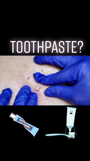 Last bit of the Tube! #zit #zitpopping #pimple #nasty #acne #fy #fypシ #gross #espinillas #juicy