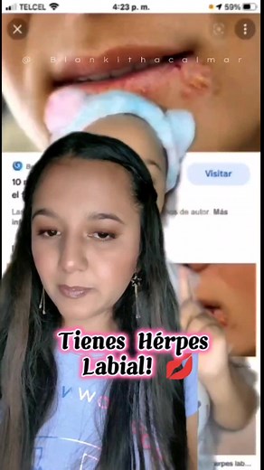 Elimina los fuegos de tu boca 👄😍👇🏻 Rapido y facil 🌿#saludbucal #herpes #herpeslabial #salud #reelsfbシ #viralreels #remedioscaseros #reels #recetasnaturales | Blankitha Calmar