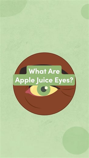 What are apple juice eyes? And what do they say about the people who have them? Find out here🍎👀 #howto #hack #lifehack #meaning #definition #trends #trendy #applejuice #applejuiceeyes | wikiHow