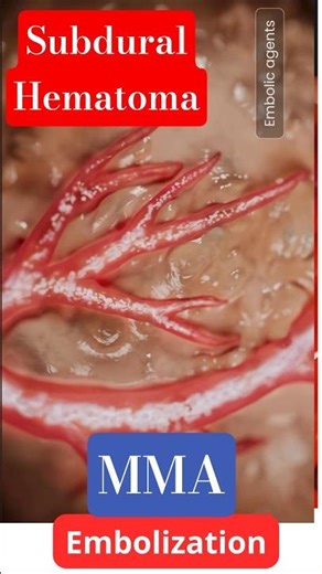 MMA embolization for Subdural hematoma. #neuroscience #mmaembolization #neuroir #sdh