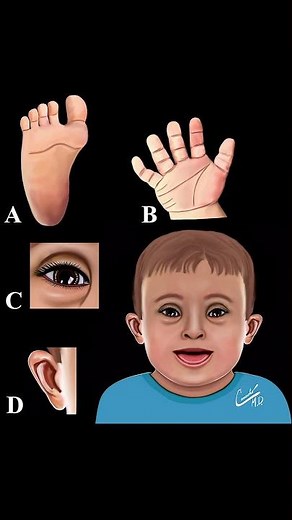 SÍNDROME DE DOWN #shorts