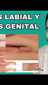 I HAVE MOUTH HERPES. HOW CAN I TREAT IT? / HOW CAN HERPES BE TREAT? | DR. DAVID CAMPOS