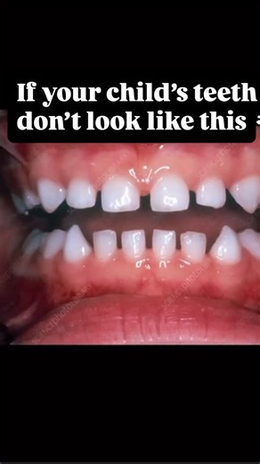 Your child’s baby teeth SHOULD have spaces between them. If they don’t, that’s not “cute” —it’s a red flag.🚩 No spacing = ❌ Jaw isn’t growing wide enough ❌ Not enough room for adult teeth (crowding is coming) ❌ Higher risk of a narrow airway ❌ Possible muscle dysfunction or mouth breathing Yes, spacing matters. Yes, this shows up early. Yes, it’s preventable if caught in time.. ✅ Spaced baby teeth = a jaw that’s growing forward and wide ✅ Room for adult teeth to erupt naturally More space for t