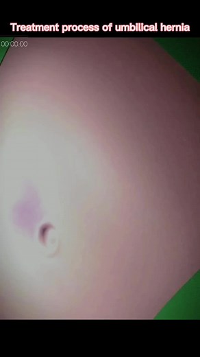 Exploring Skin Health: Pimple Extraction Procedure