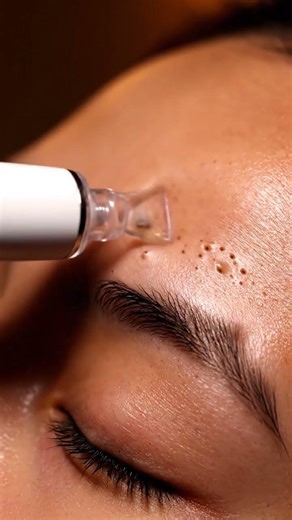 “Oddly Satisfying Blackhead Extraction Compilation”