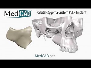 Orbital-Zygoma Custom PEEK Implant - Render