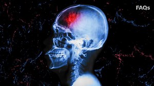 The science of strokes: How they happen, who is most at risk