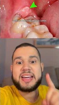 Pericoronaritis no tooth Siso
