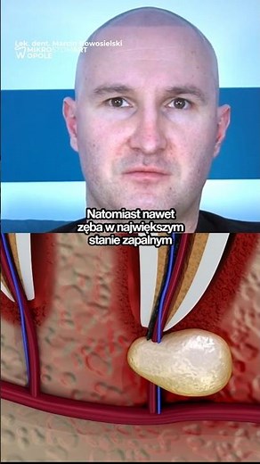 TOOTHACHE with INFLAMMATORY CONDITION? 😣🦷 Dentist: EVEN THE MOST DISEASED TOOTH CAN BE ANAESTHESI...