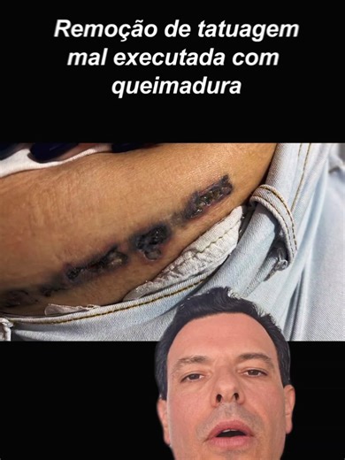 Ulceração após a remoção de tatuagem? 🚨 Isso nunca é um bom sinal e precisa ser levado a sério. Quando ela aparece, geralmente significa que houve um dano tecidual além do esperado. Na maioria das vezes, estamos falando de sobrecarga energética e acúmulo térmico. Se a energia aplicada ultrapassa a capacidade da pele de dissipar calor, principalmente em pigmentos mais profundos ou quando não há resfriamento adequado, o tecido pode sofrer um dano térmico importante. E esse processo, muitas vezes,