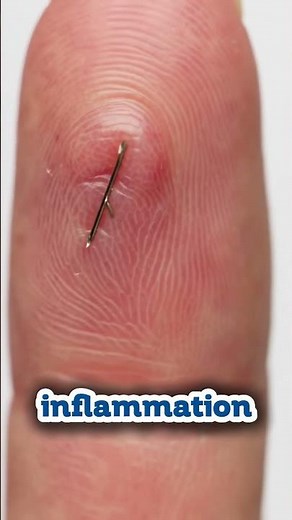 How splinter come out of the body