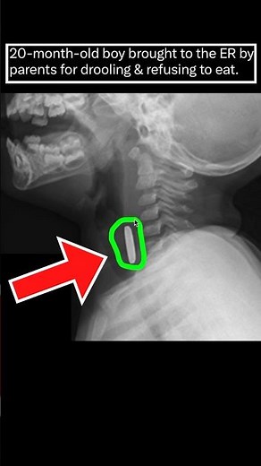 This 20-month-old boy swallowed a button battery, here's what happens next #medical #emergency