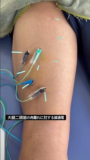 大腿二頭筋の肉離れに対する電気鍼