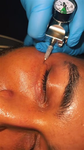 Revitalize Your Look with Carboxy Therapy for Under Eyes