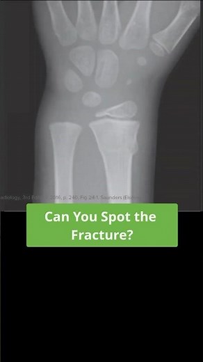 Pediatric Wrist Fractures: Recognizing Torus Fractures 👶