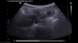 3.7K views · 62 reactions | The great role of U/S in acute abdomen, a very clear case of acute appendicitis. Rigester in our recorded online course to learn too many critical care U/S tricks which will change your way of management and boost your ICU skills. For registeration in our course, kindly contact us at 00201153949331, 00201023501450 WhatsApp | Hands on critical care U/S courses | Facebook