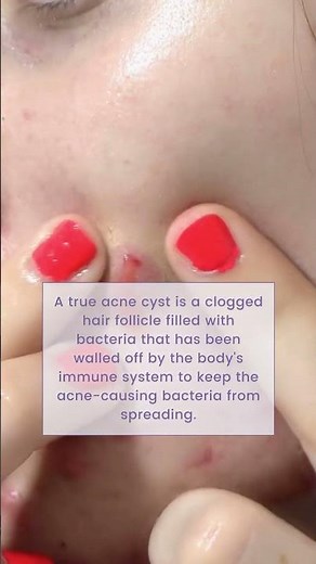 Why does cystic acne happen? | Skin Type Solutions