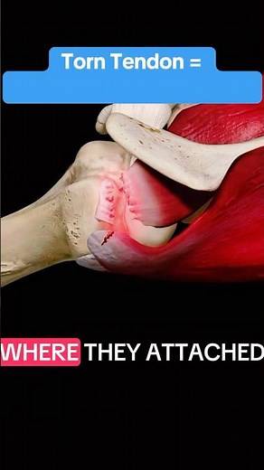 Rotator Cuff & Tendon Tears Explained