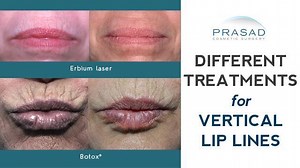 How Vertical Lip Lines/ Lip Wrinkles can be Treated and Improved with Minimal to No Downtime