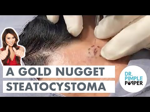 A Gold Nugget Steatocystoma