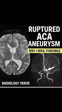 “MRI & MRA Brain Showing Ruptured ACA Aneurysm | Radiology Case Explained”
