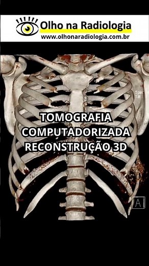 TOMOGRAFIA COMPUTADORIZADA RECONSTRUÇÃO 3D #tomografia #radiologia #imaginologia #rxking #rx