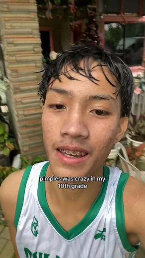 Grade 10 Pimples: Surviving Severe Acne in High School