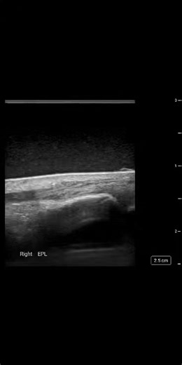 22 reactions · 6 comments | Put your thumbs up if you know how to evaluate the extensor pollicis longus is intact on ultrasound. If you can't find out how at www.iame.com | SonoWorld | Facebook