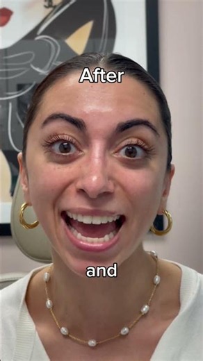 Rhinoplasty Before and After (One Year Post-Op) - Dr. Janjua