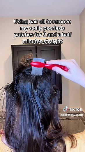 Removing Scalp Psoriasis Patches with Fluocinolone Acetonide | Satisfying Removal