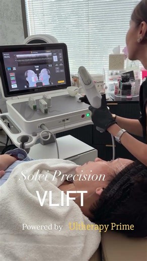 This is the Solei Precision VLift #soleiclinic #ultherapyprime