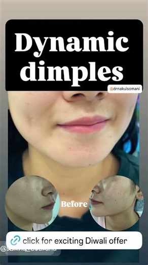 Dimple creation surgery in Jaipur by Dr. Nakul Somani, expert cosmetic surgeon. 📞 8290000117