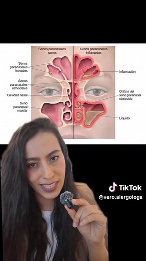 Cómo aliviar la sinusitis de manera efectiva