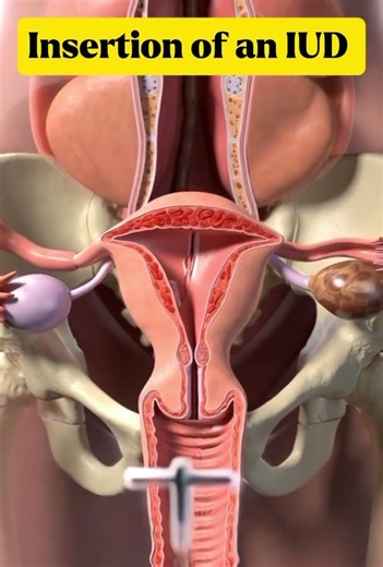 How an IUD Is Inserted Inside the Uterus 3D Animation.