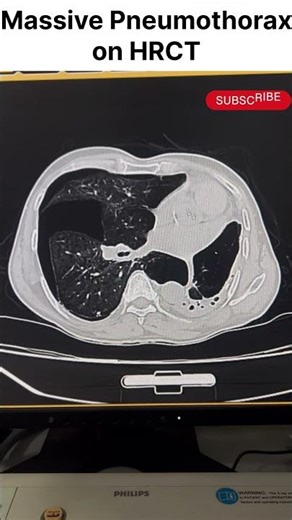 Massive Pneumothorax on HRCT | Collapsed Lung #Shorts