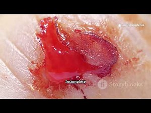 The Hidden Risks of Male Circumcision - What Doctors should tell you