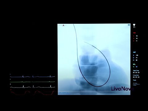 ProtekDuo® Insertion