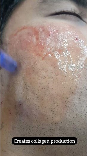 Dermapen for acne scars