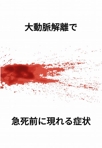 健康チェック：大動脈解離のリスクについて