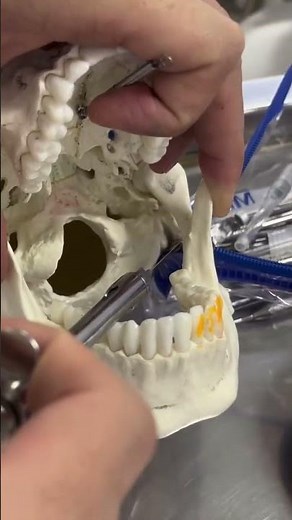 inferior alveolar nerve block #dentaleducation #dentalhealth #dentalartistry #dentalprosthesis