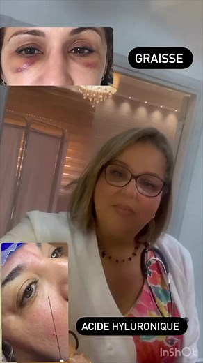 Comblement des cernes la différence entre la graisse &acides hyaluronique cette différence vous pouvez vous meme faire la différence et choisir le meilleur traitement | Docteur hank médecin esthétique & anti âge