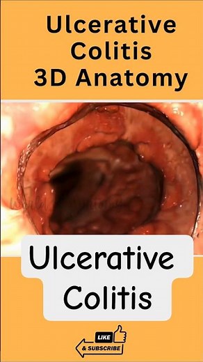 Ulcerative Colitis in 3D 🔥 | Inflammation Inside the Colon