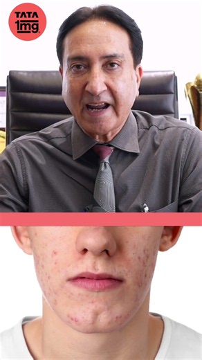 Top 3 Causes of Acne You Didn't Know