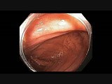 Colonoscopy - Cecum - Subtle Lesion • Video • MEDtube.net