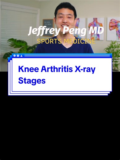 Knee Arthritis X-ray Stages: What You Need to Know