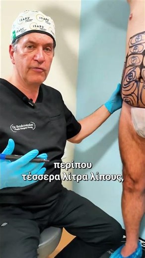 3D Λιποαναρρόφηση