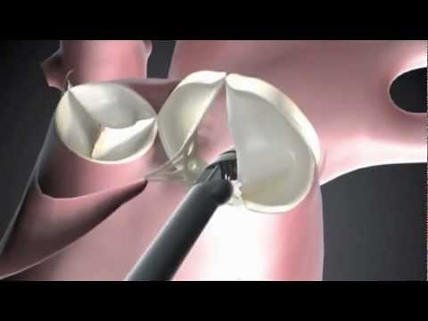 NeoChord DS1000 Chordae Replacement System - MDEA 2013 Silver Winner