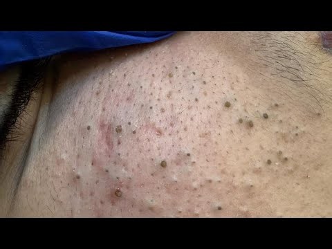 Ultimate Pimple Purge | Deep Cleansing Techniques & Acne Solution Routine
