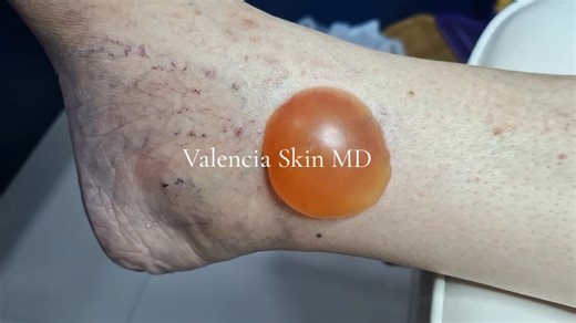 1.9K views · 11 reactions | Let's test your skin acumen! What do you think this is? A. Blister from burn B. Skin tumor C. Diabetic complication D. Skin abscess Clue: It is usually found in older men with decreased immunity. Guess away! :) #ValenciaSkinMD #SkinExpertiseWithinYourReach #PDSBoardCertifiedDermatologist#DermatologicSurgery | Valencia Skin MD | Facebook